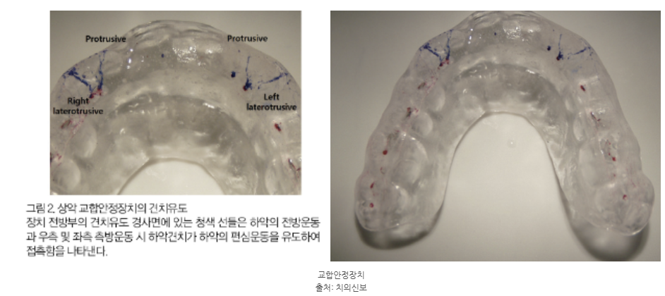 하남미사턱관절치과, 자고 일어나면 턱이 아픈 이유와 치료 방법 <의사 작성> 4