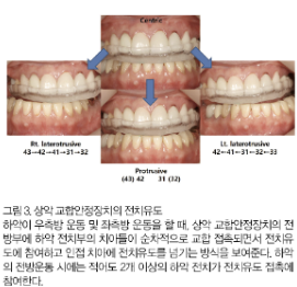 하남미사턱관절치과, 자고 일어나면 턱이 아픈 이유와 치료 방법 <의사 작성> 5
