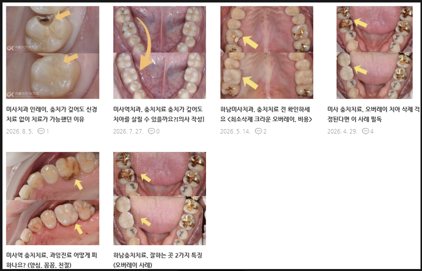 하남치과 충치치료, 왜 어떤 레진은 티가 나고 어떤 레진은 안 날까요? <레진치료사례1> 5