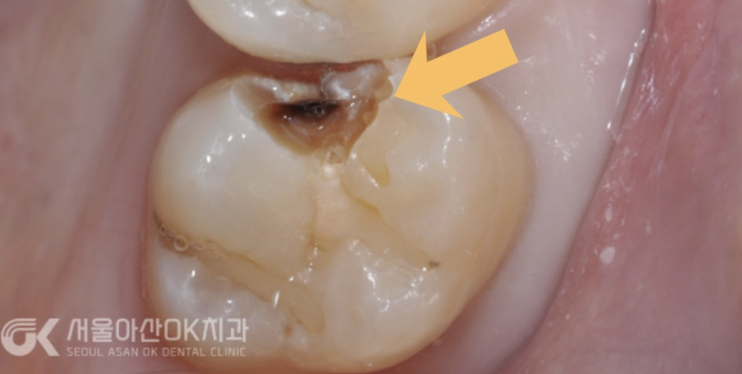 미사치과 인레이, 깊은 충치인데 신경치료를 하지 않은 이유 1 <실제 사례> 6