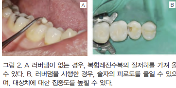 하남치과 충치치료, 왜 어떤 레진은 티가 나고 어떤 레진은 안 날까요? <레진치료사례1> 1